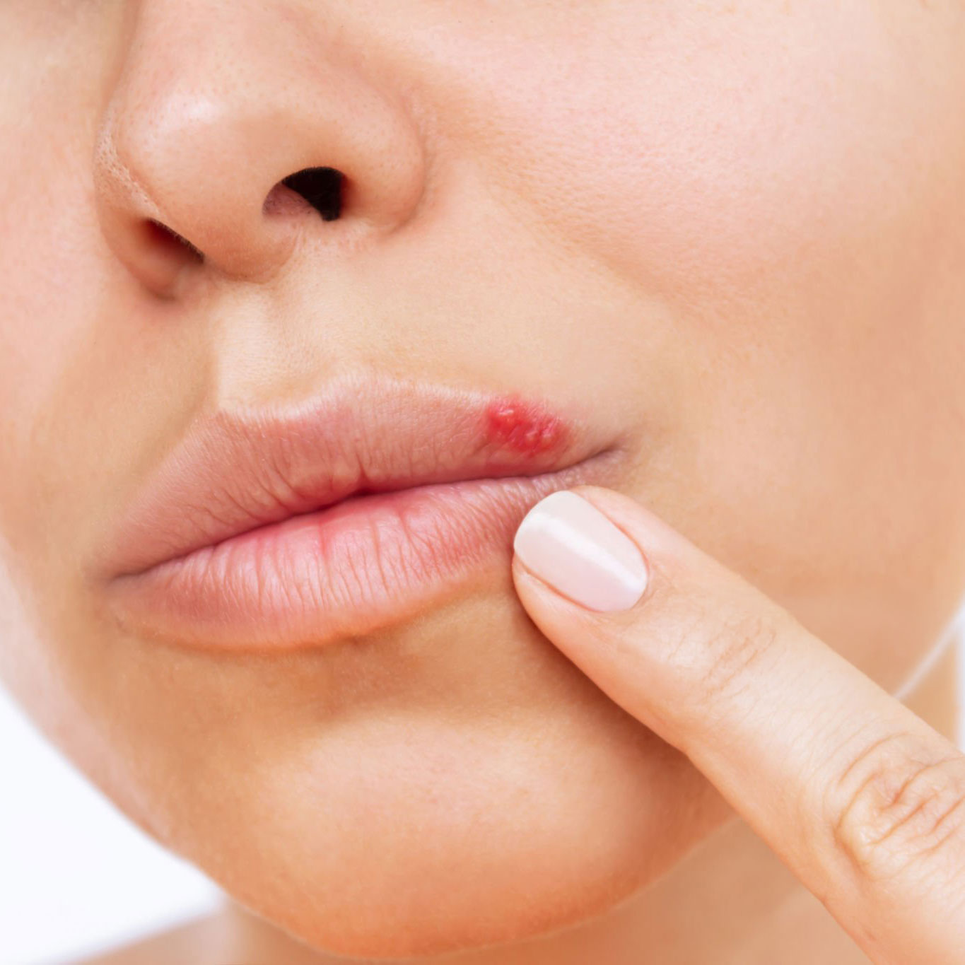 Herpes simplex