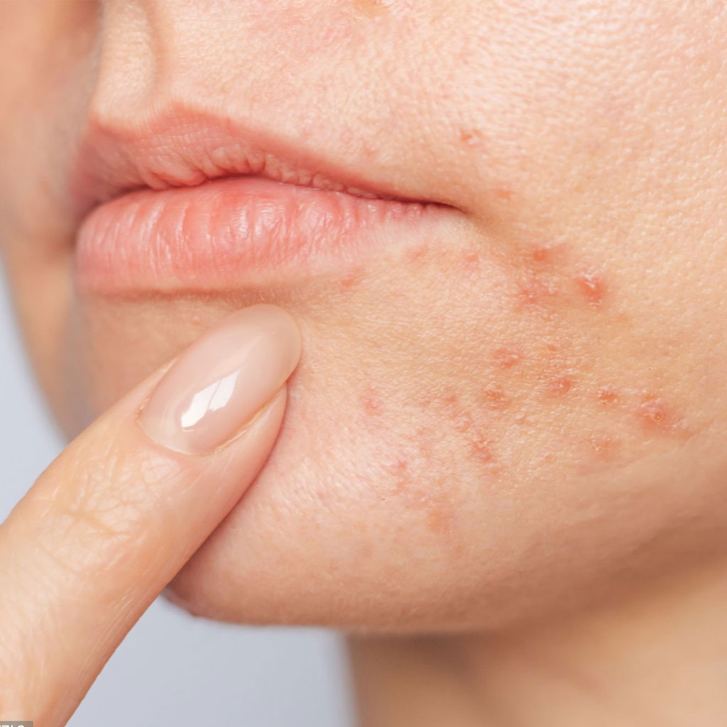 Acne During Summer – Why Does It Improve in Some People and Worsen in Others?