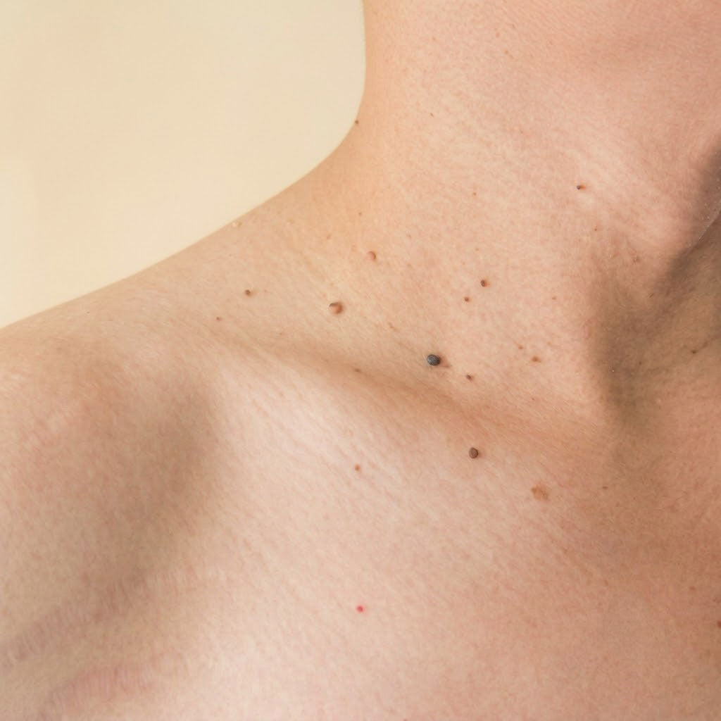 Fibromas / Papillomas