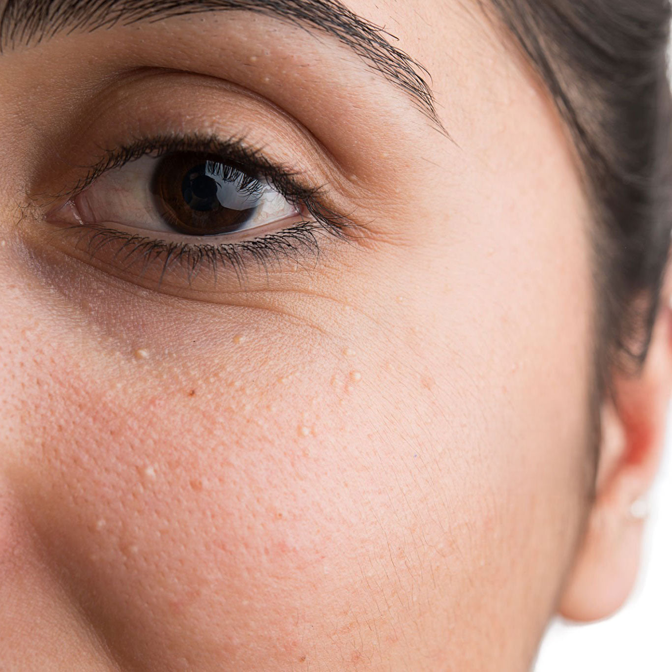 Milium - Milia