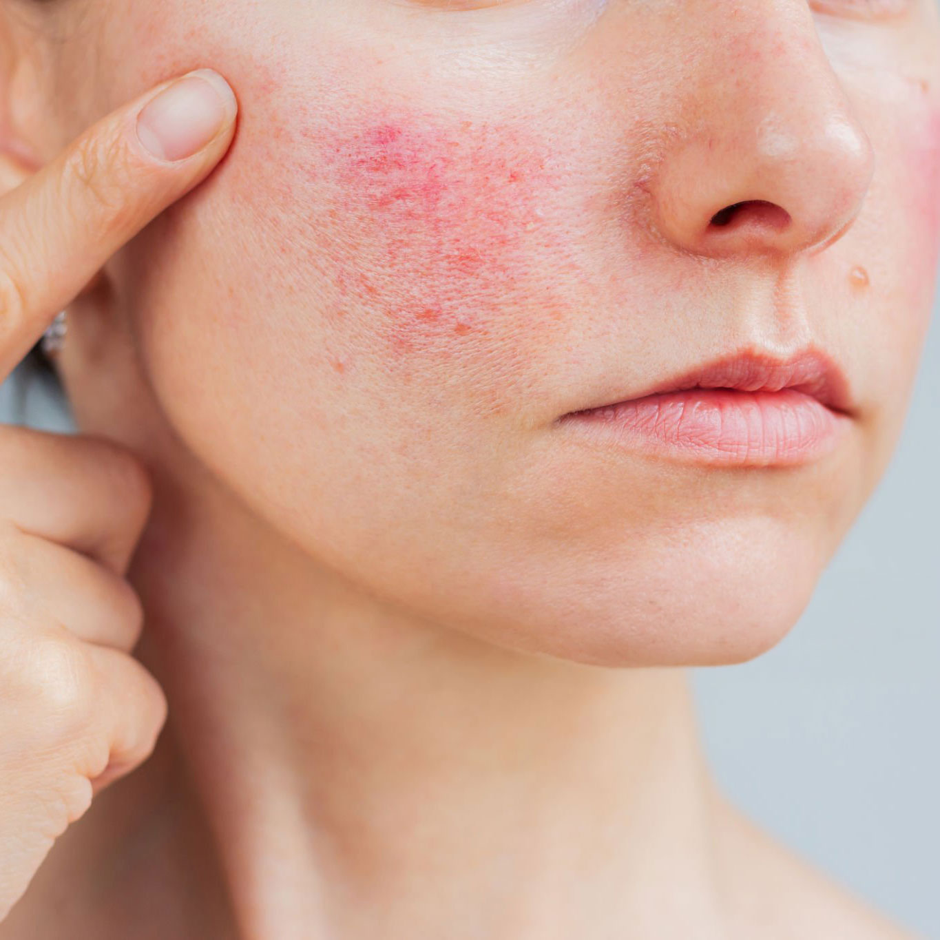 Rosacea