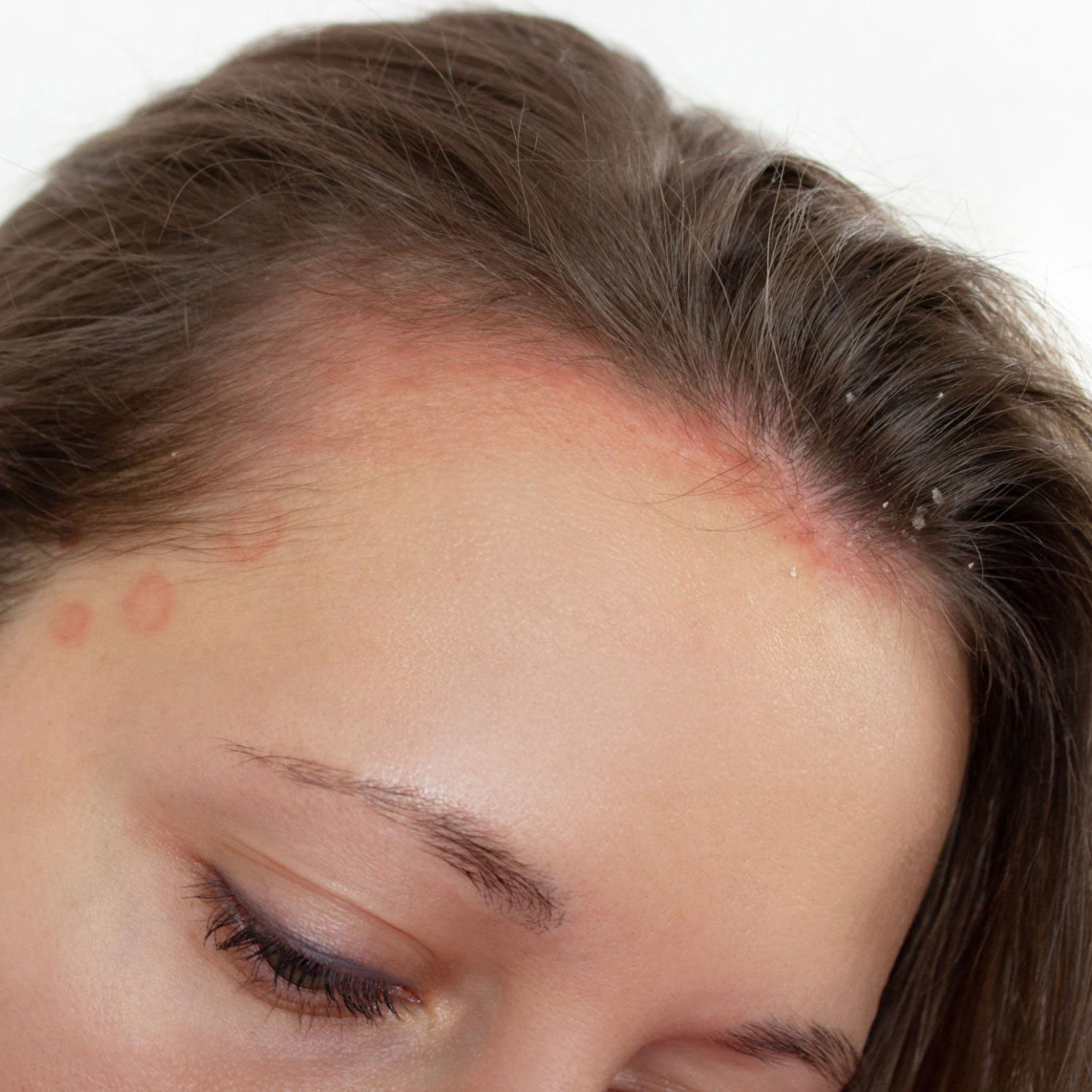 Seboroični dermatitis